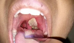 diphtheria-300x176 NMA Condemns Arrest of Prof. Martin Aghaji, Demands Due Process and Justice